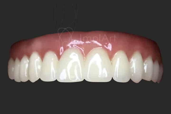 proteses metal free fixa total sobre implantes protese de zirconia, prótese dentária em computador