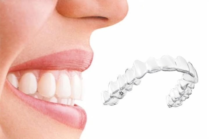 invisalign alinhador transparente