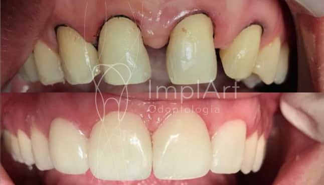 diastema agenesia lente contato dental 50kb