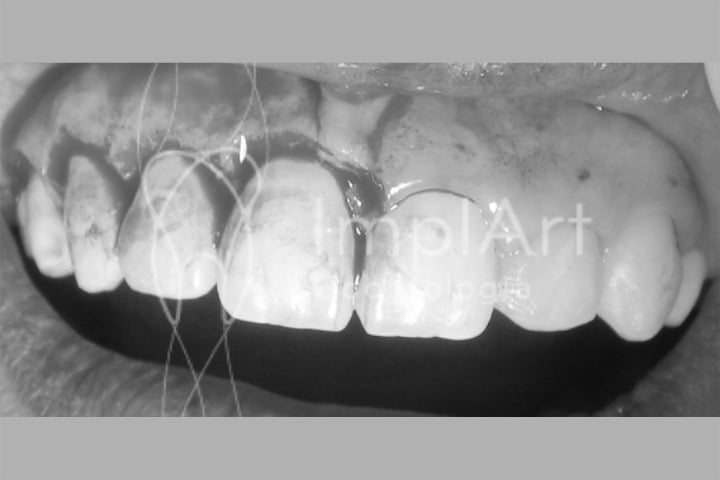 como é a cirurgia do sorriso gengival gengivectomia