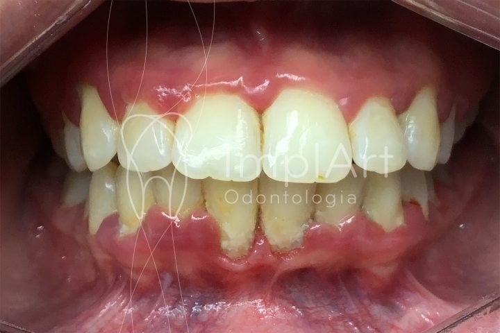 Fumar aumenta o risco de doenças periodontais, como gengivite e  periodontite, devido à redução da circulação sanguínea nas gengivas. Além…