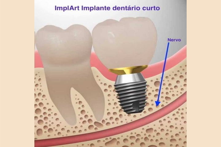 implante dentário curto
