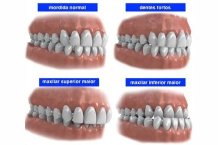 problemas de oclusao dentaria