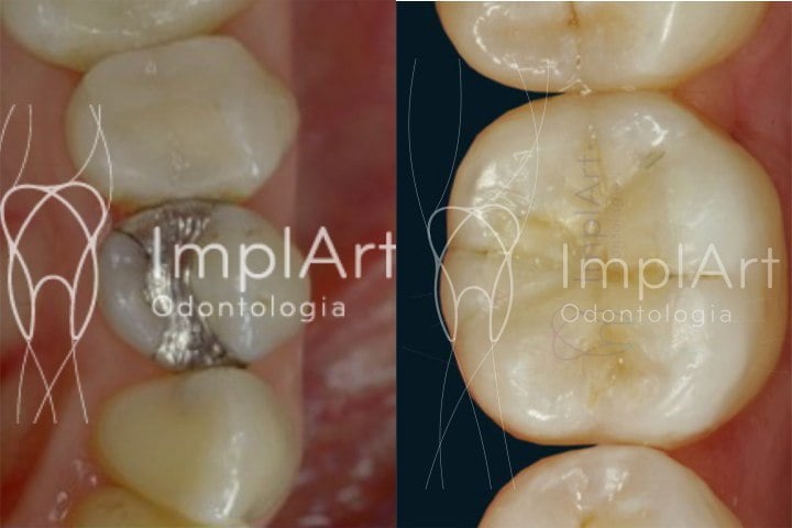 restaurações dentárias