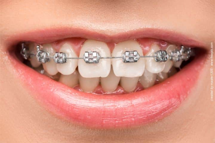 aparelho ortodontico convencional 50kb