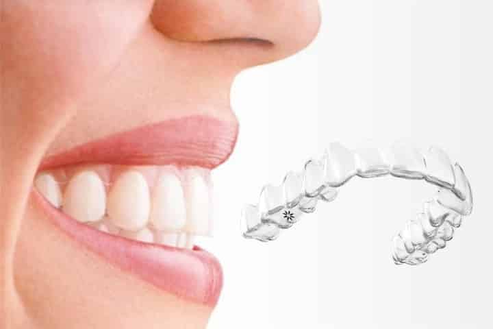 invisalign alinhador transparente 