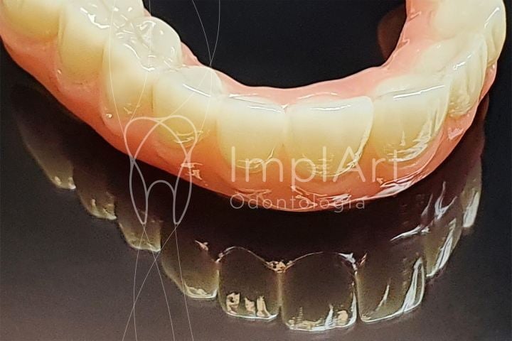 protese provisoria para implantes dentarios