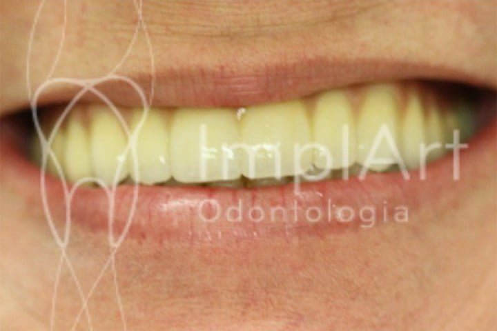O papel da prótese provisória no tratamento com implante dentário - paciente não fica sem dentes 3 protese provisoria total 50kb