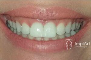 implante dentario de dente frontal