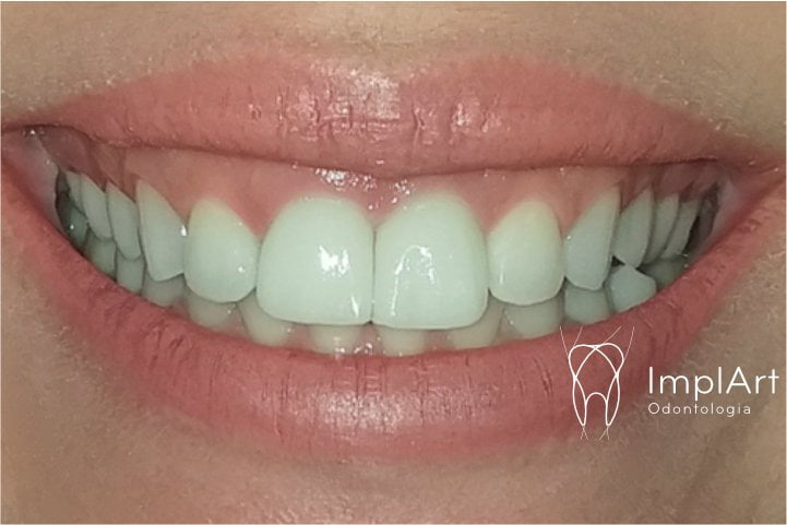 foto do resultado do tratamento de implante dentario dente da frente