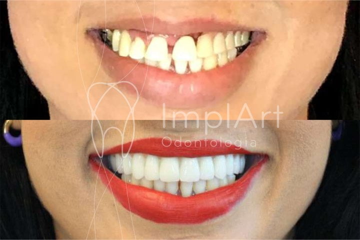antes e depois reabilitacao oral protese metaloceramica 49kb