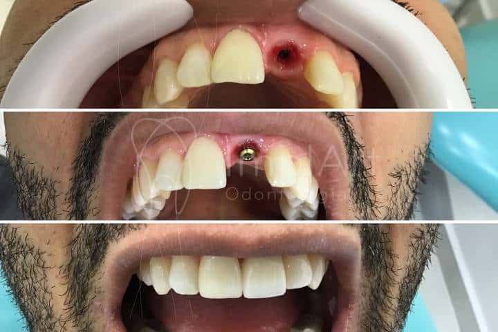 coroa de porcelana para implante unitário para repor um dente perdido