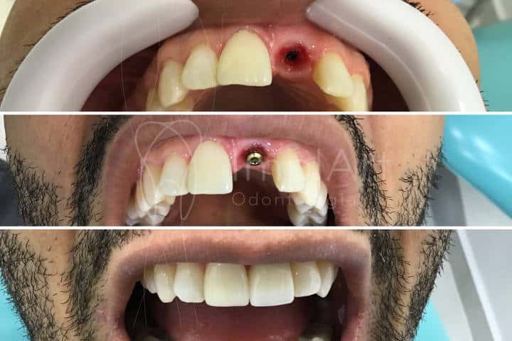 reposição de dente com implante dentário e coroa CAD/CAM