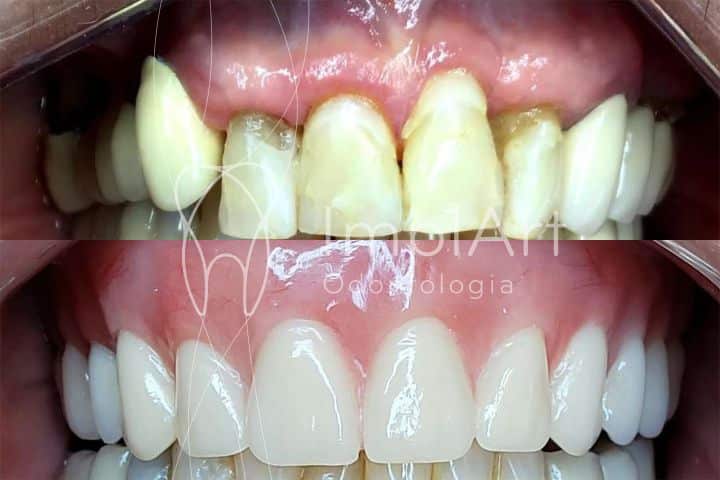 Prótese protocolo dentário de resina antes e depois