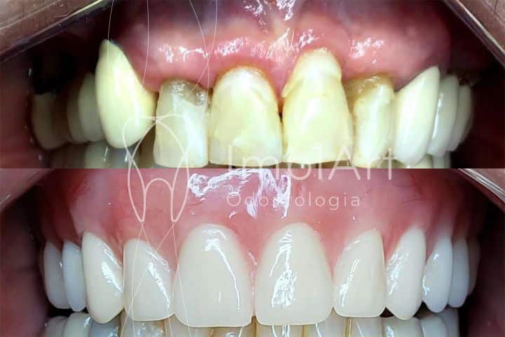 PRÓTESE PROTOCOLO SOBRE IMPLANTES
