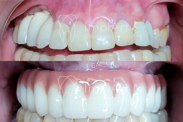 implante total protese metaloceramica antes e depois 50kb