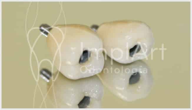 protese metaloceramica para implantes unitaria 50kb