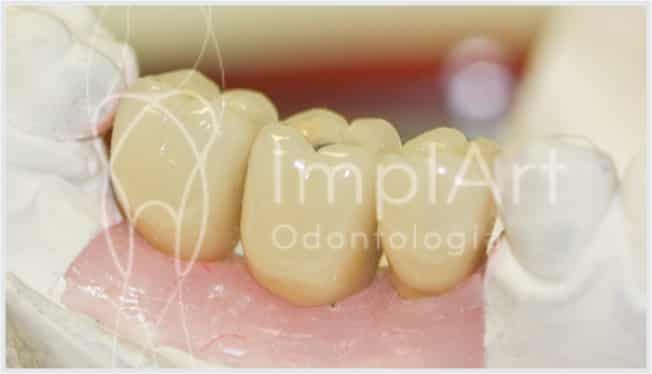 protese metaloceramica para implantes varios dentes 45kb