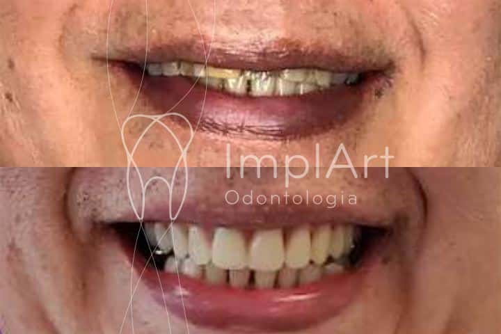 Prótese protocolo dentário ade porcelana após remoçao de todos os dentes antes e depois