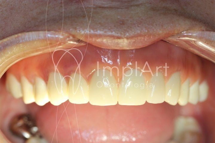 PROTESE PROTOCOLO ARCADA SUPERIOR SOBRE IMPLANTES