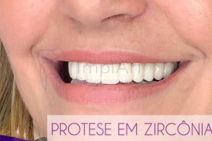 protese fixa em porcelana implante dentario