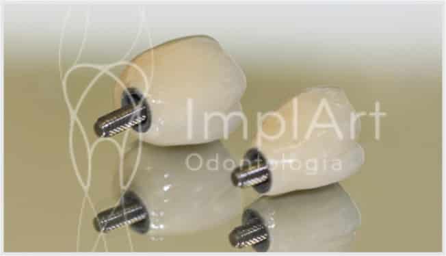proteses metaloceramicas para implantes individuais 45kb