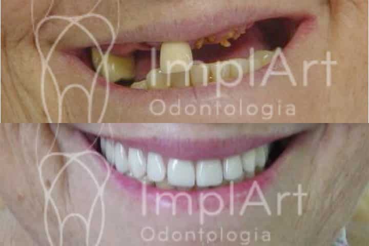 Prótese protocolo dentário de resina com carga imediata antes e depois