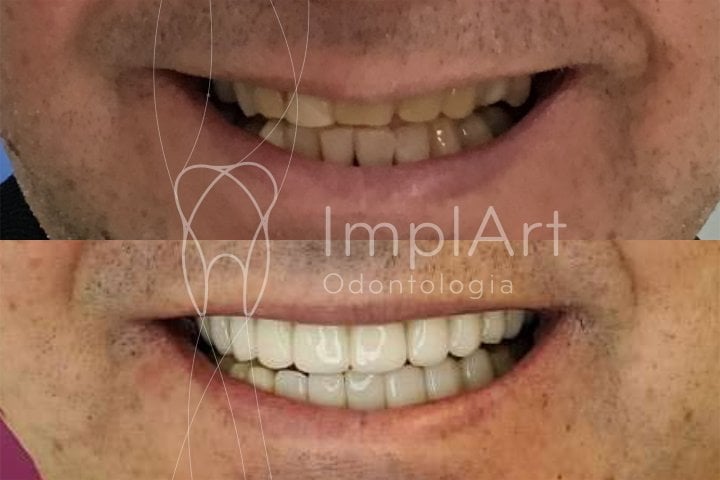 reabilitacao protese metaloceramica antes e depois 49kb