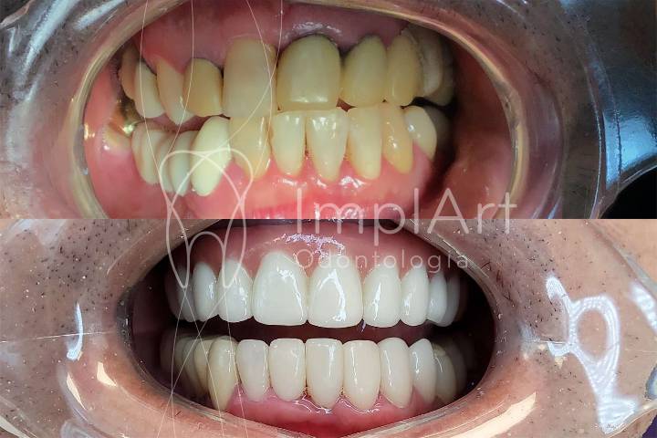 reabilitacao protese metaloceramica antes e depois 50kb