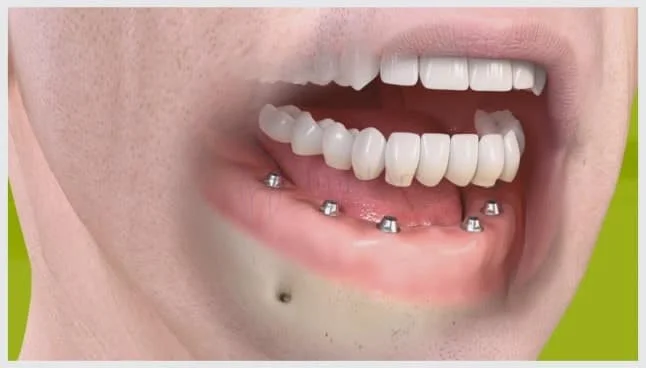 implante total implante completo implante de todos os dentes
