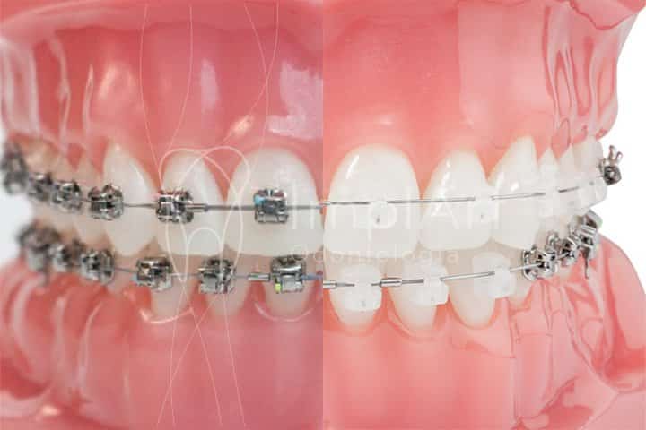 aparelho otodontico autoligado para corrigir os dentes