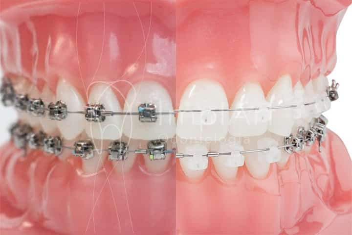 aparelho ortodôntico autoligado