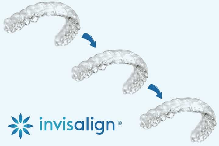 Alinhador transparente Invisalign 4 alinhador implart transparente invisalign valor