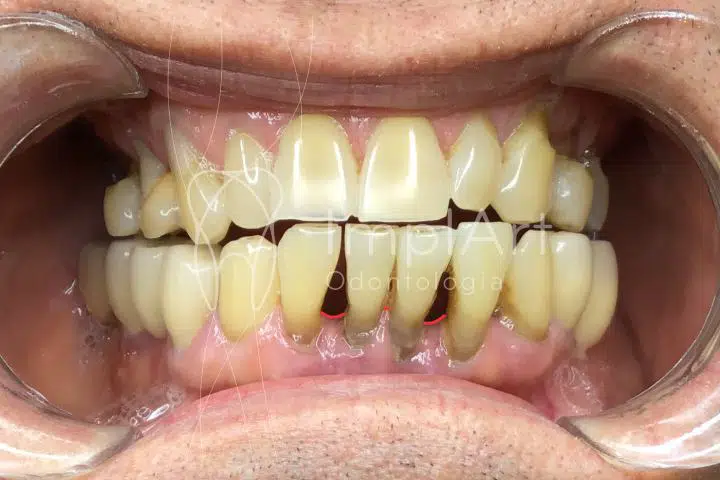 doença periodontal espaço entre dentes blackspace dental dentes inclinados perda óssea e retração gengival