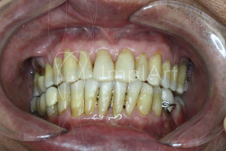 dentes com periodontite avançada se tornam dentes amolecidos