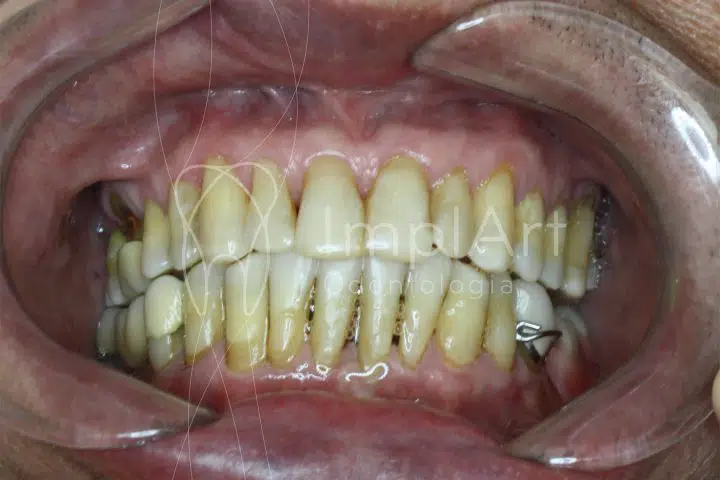 doença periodontal perda óssea