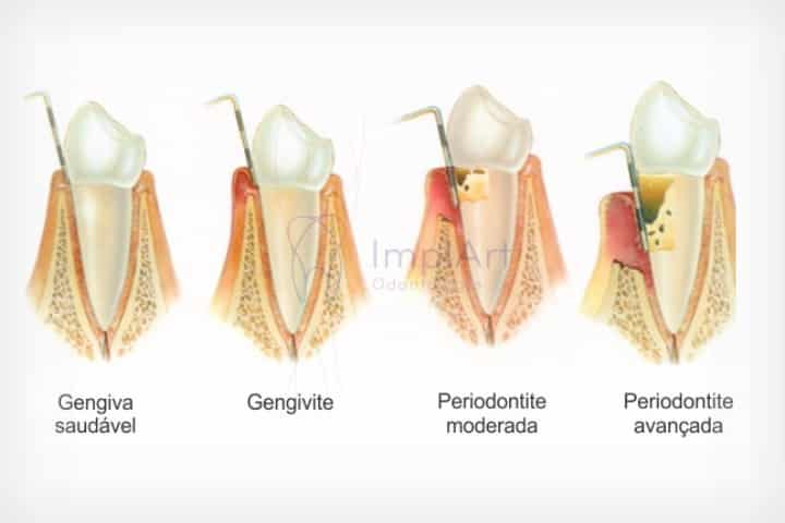 avanço da periodontite leva a perda de dentes