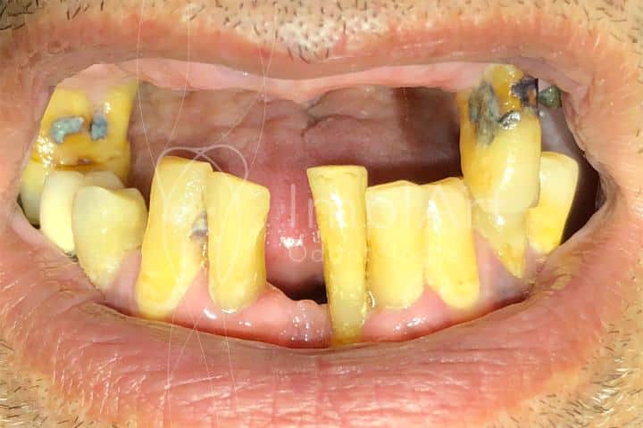 doença periodontal dentes moles dente caindo