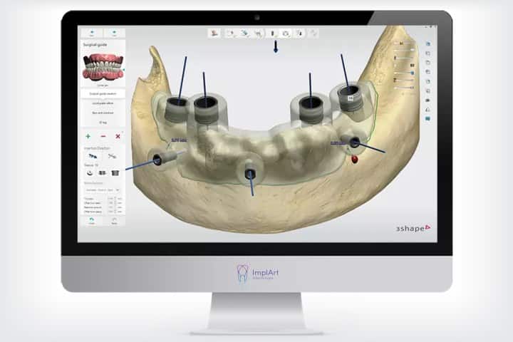 planejamento computadorizado da cirurgia de implante dentário
