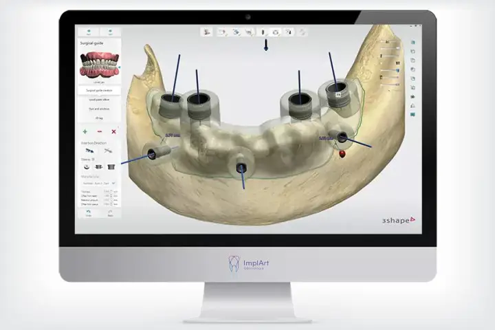 guia cirúrgica para implantes dentários cirurgia guiada cirurgia computadorizada