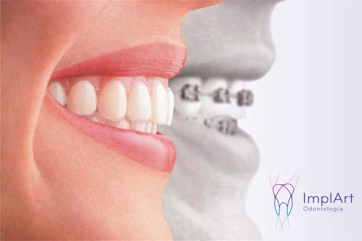 Principais dúvidas sobre o tratamento com Invisalign em São Paulo - ImplArt