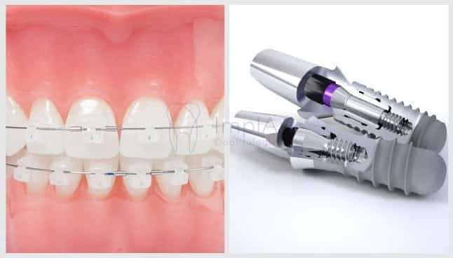 integração ortodontia e periodontia