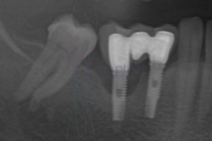 ums dos riscos para implantes dentários é a peri implantite