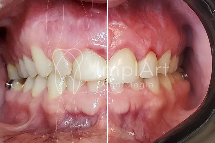 sorriso gengival gengivectomia coroas emax antes e depois 50kb 1