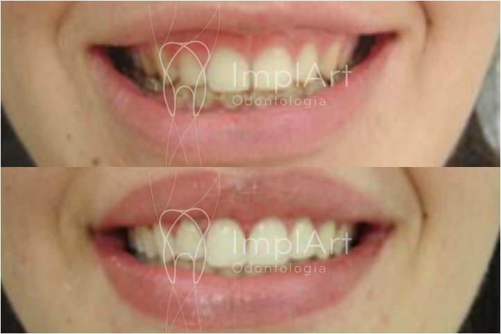 sorriso gengival tratamento antes e depois 50kb