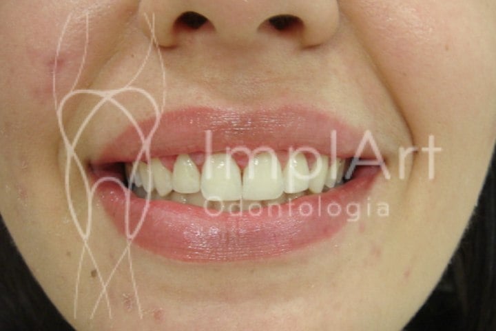 tratamento sorriso gengival antes e depois 49kb