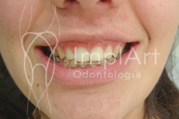 tratamento sorriso gengival antes e depois 50kb