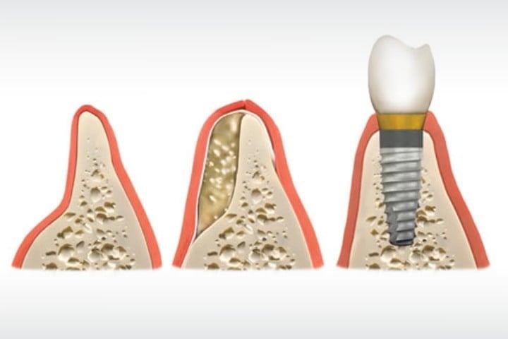 video de implante dentário