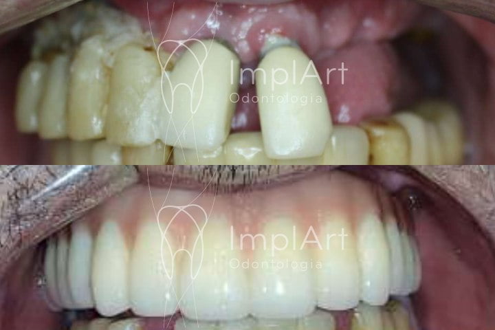 reabilitacao oral implantes protese zirconia 50kb