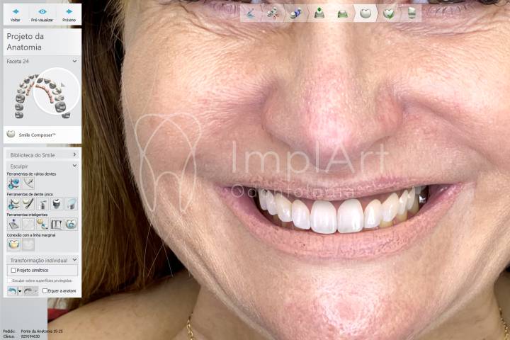 projeção digital de lentes para testar formatos dos dentes combinando com o biotipo facial